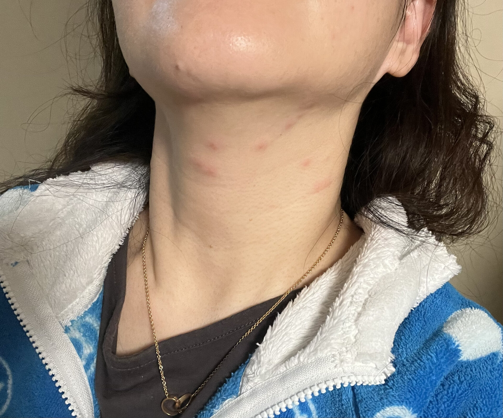 求医:脖子上突然长了好多红疙瘩,痒