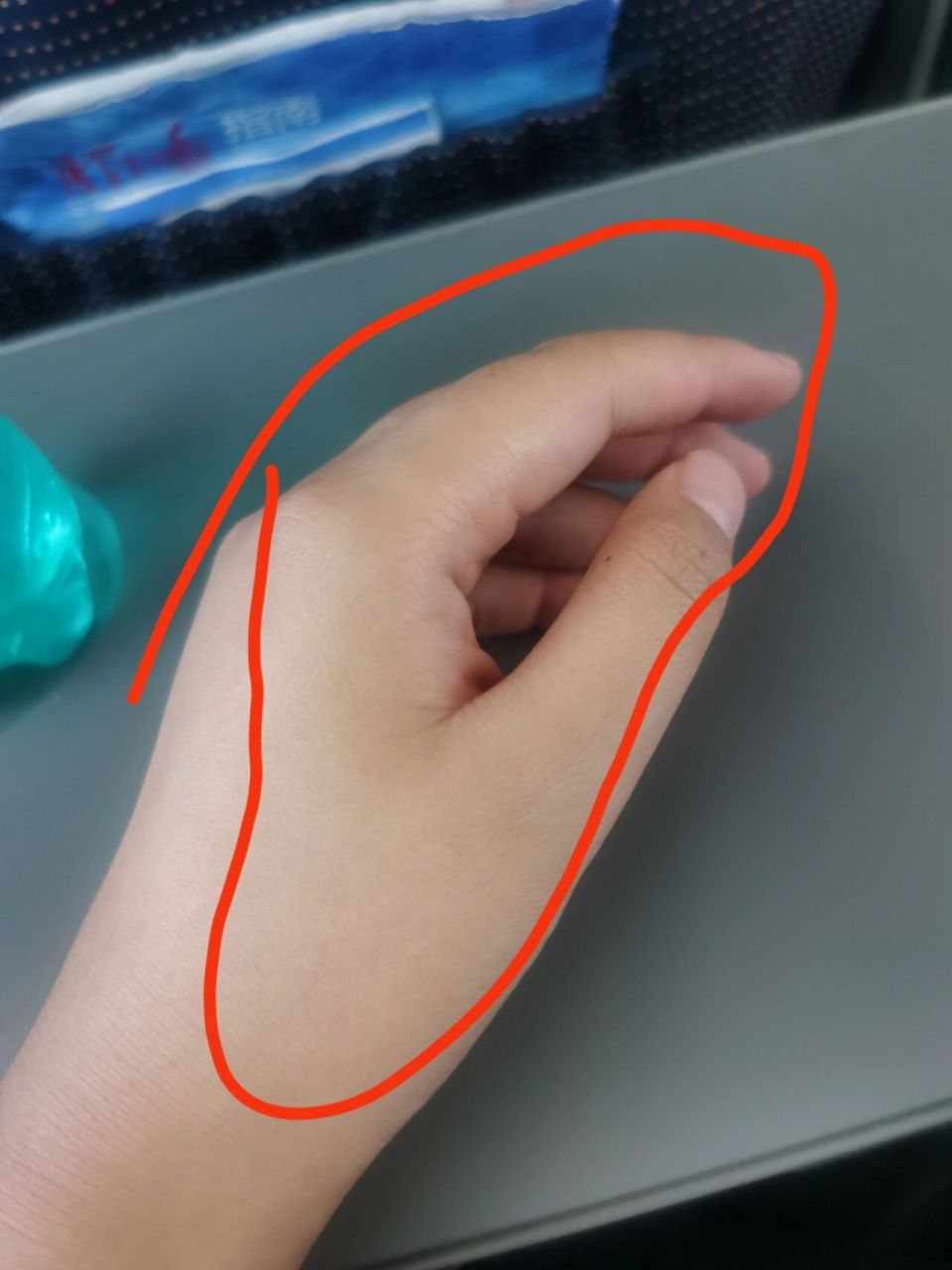左手大拇指和食指麻木7999 今天一早起床 还以为睡觉压麻了94