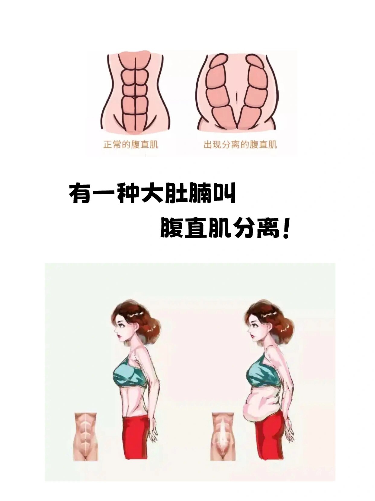 腹直肌分离几指算正常?