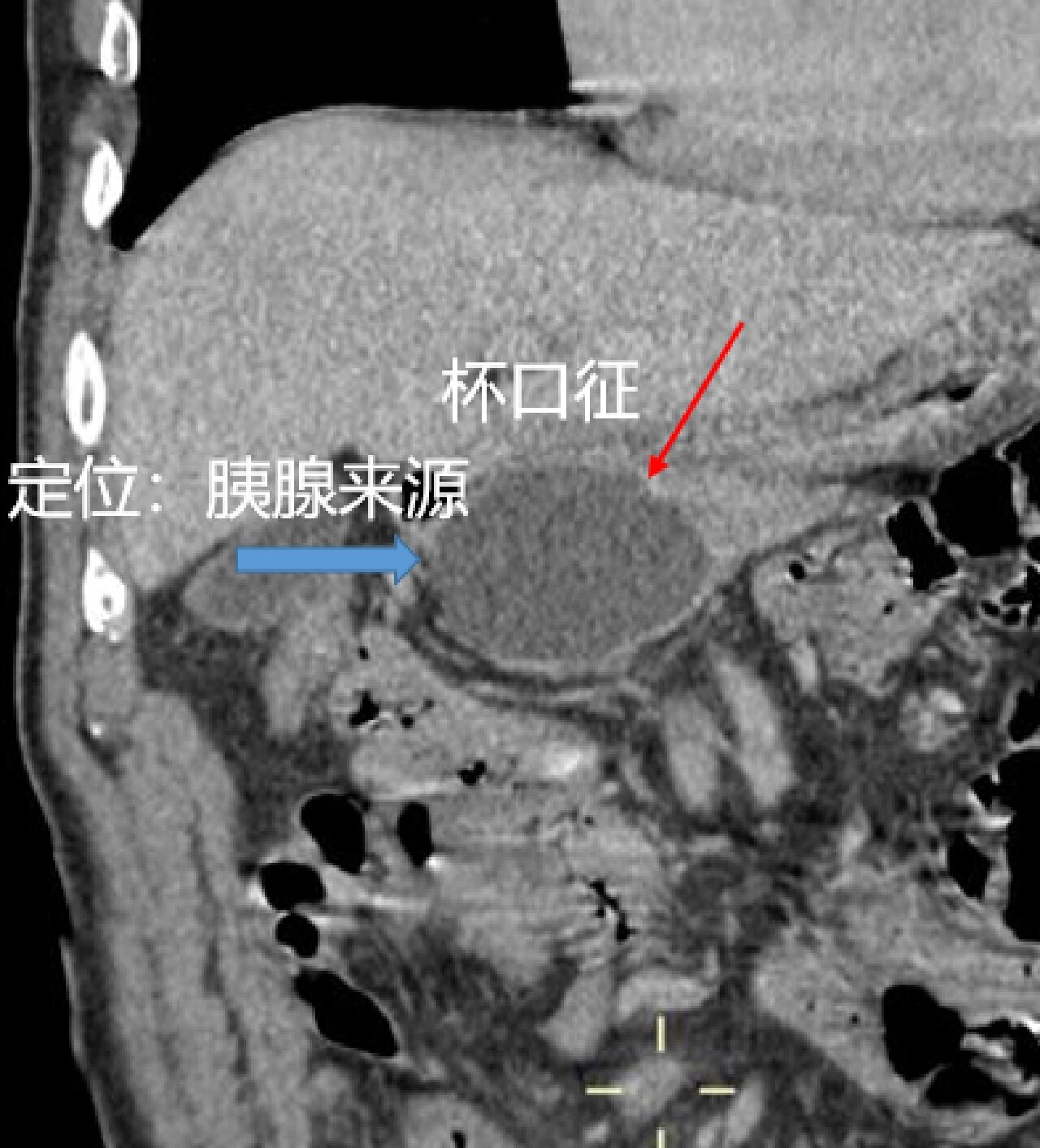 胰腺结节图片