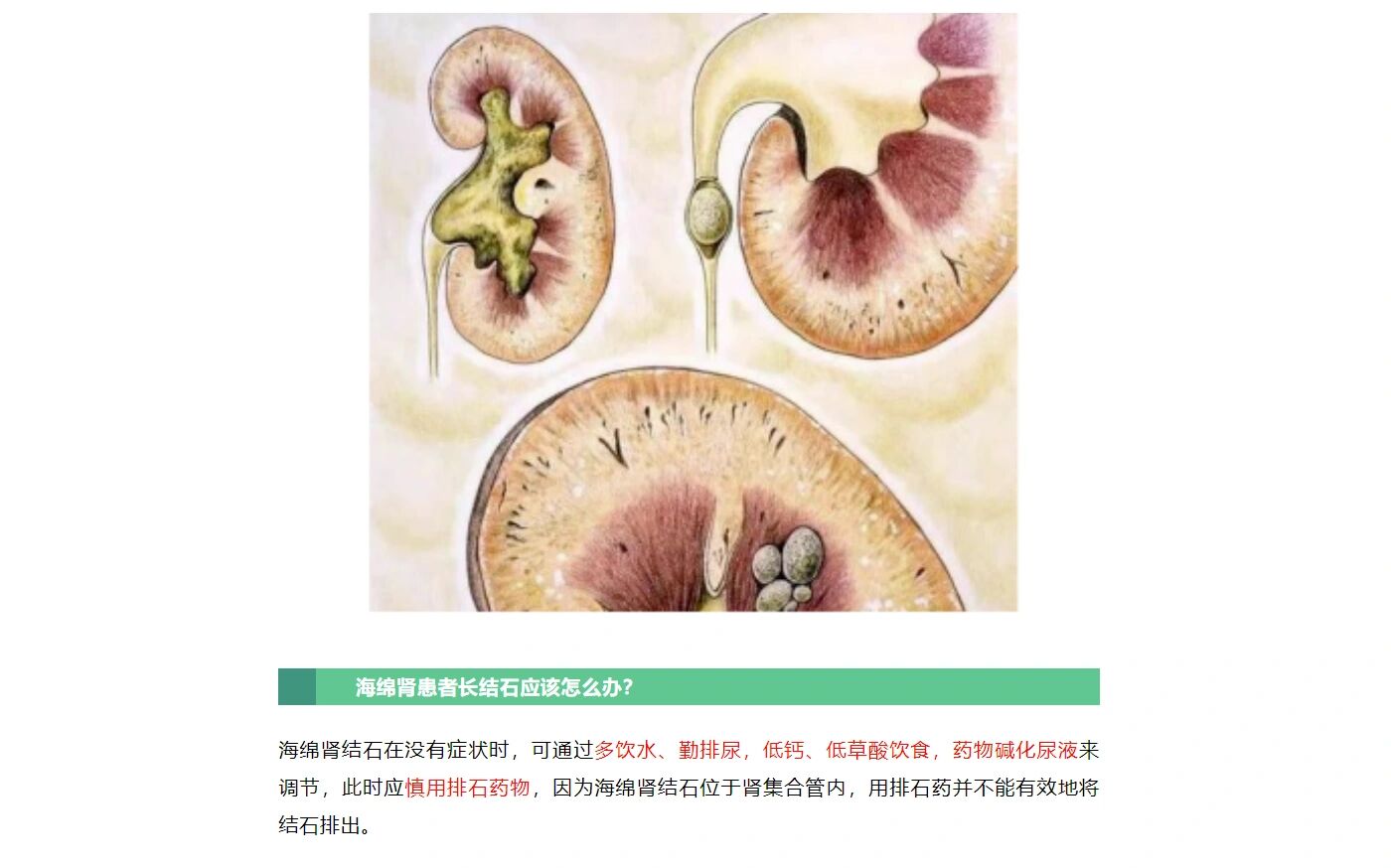 海绵肾与肾结石