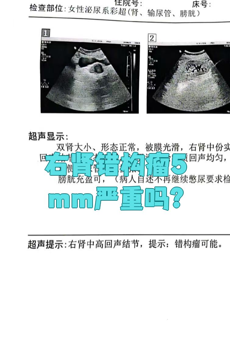 5mm的右肾错构瘤需要重视,虽然它属于良性肿瘤,但仍有破裂出血的
