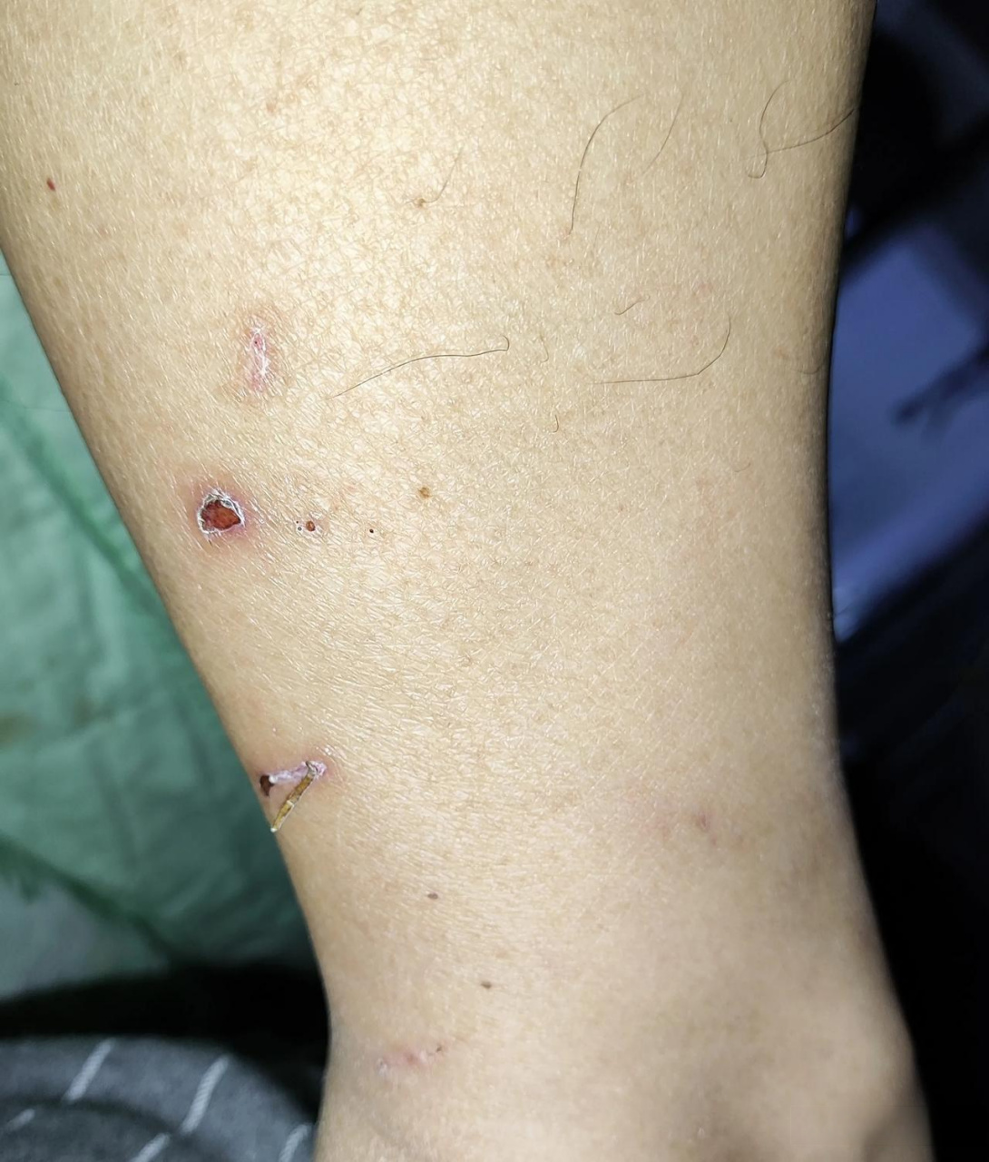 前些天不小心小腿上搞上伤疤了,很小的一点.