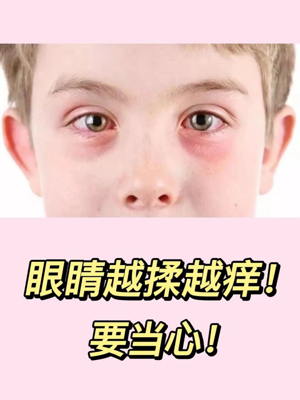 眼睛越揉越痒,尤其是眼角特别痒,可能是眼睛过敏啦,出现过敏性结膜炎.