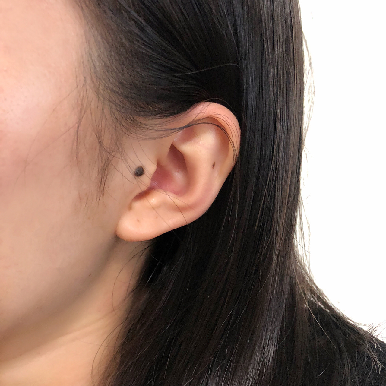 耳朵大肉痣 要去切掉嘛 会不会病变?