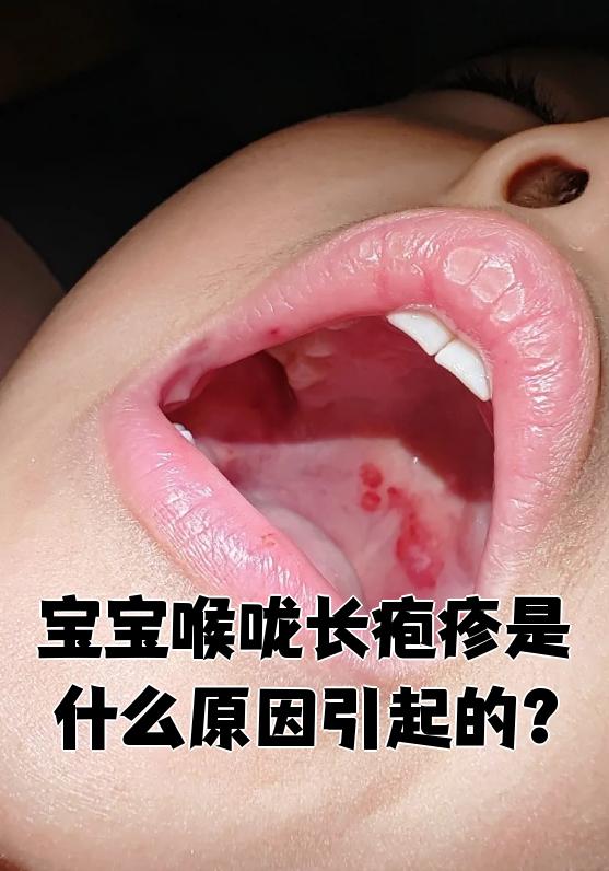 宝宝喉咙长疱疹常见的原因有病毒感染,细菌感染,过敏反应,环境刺激