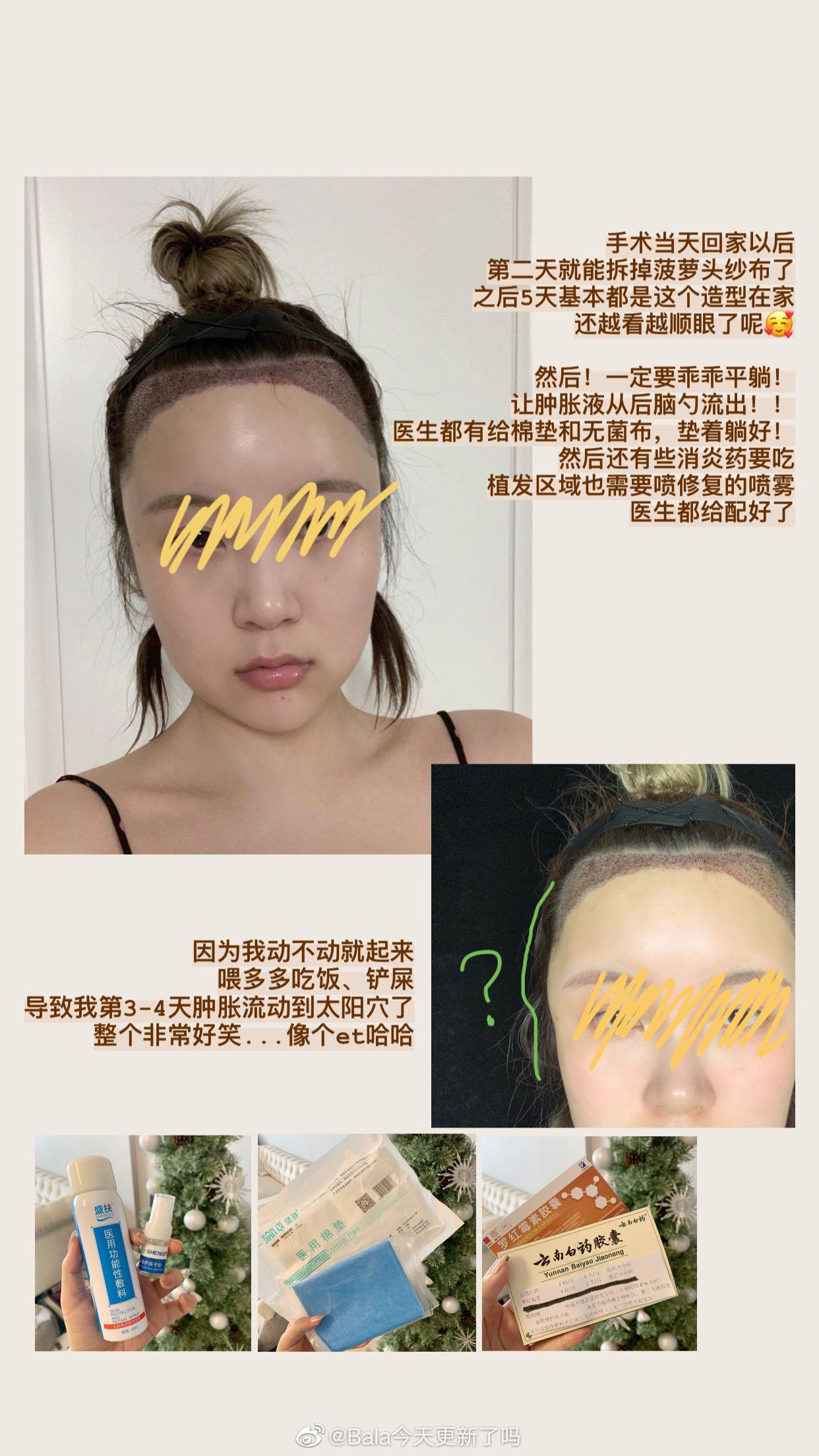 植发后头发存活多久正常(植发后头发存活多久正常生长)