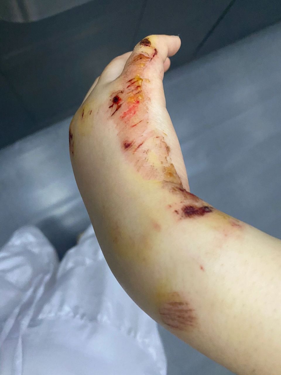 乐极生悲|火了篇笔记却摔伤了手. 怎么这么抓马01