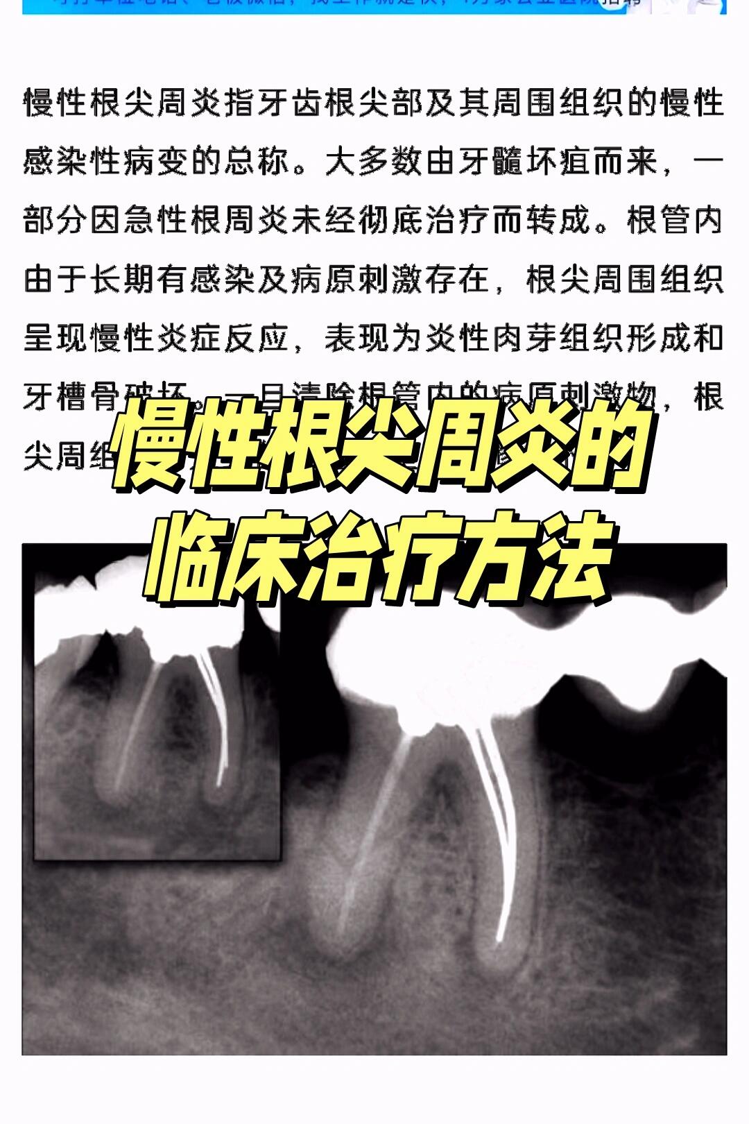 口腔学习打卡day17丨慢性根尖周炎如何处理
