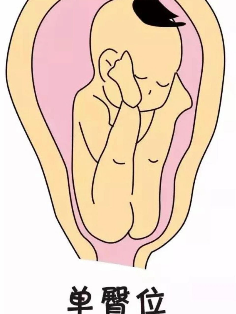 29周b超臀位且脐带绕颈一周,自己没敢在家里做胎位纠正姿势.