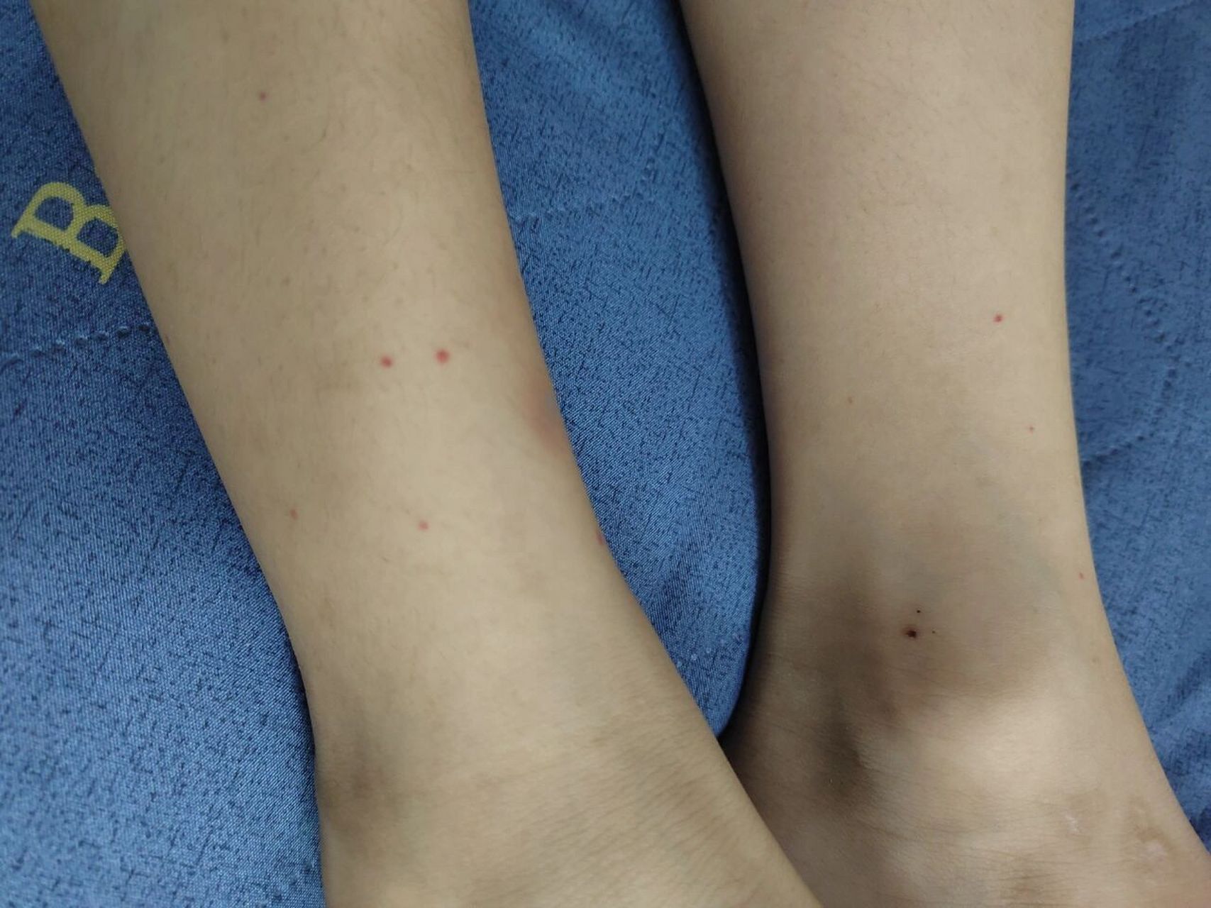 过敏性腹部紫癜治疗快一年了,刚出院十天,中药和西药一起吃着,晚上