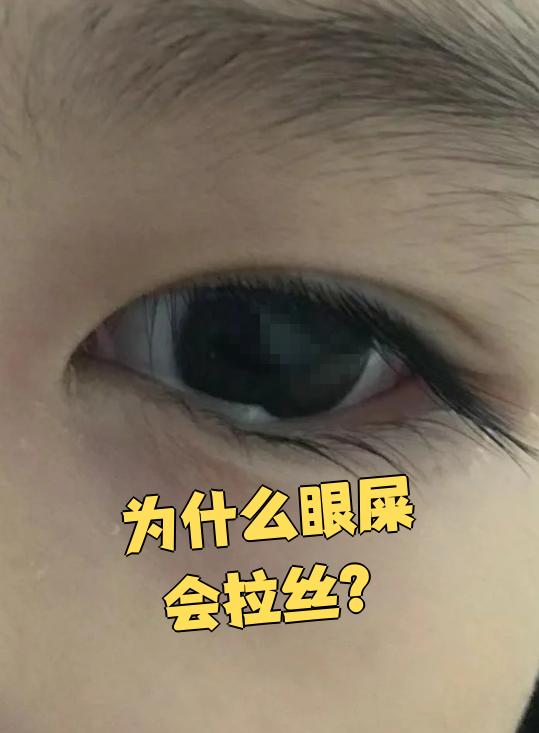 眼屎拉丝通常和下面这些原因有关: