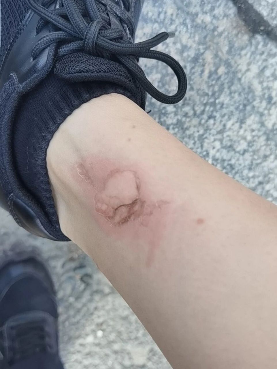 摩托车烫伤第一天