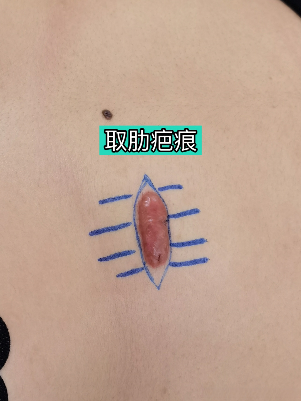 防止留疤 在鼻整形中取自体肋骨隆鼻是很常见的,一般来说,取肋的切口