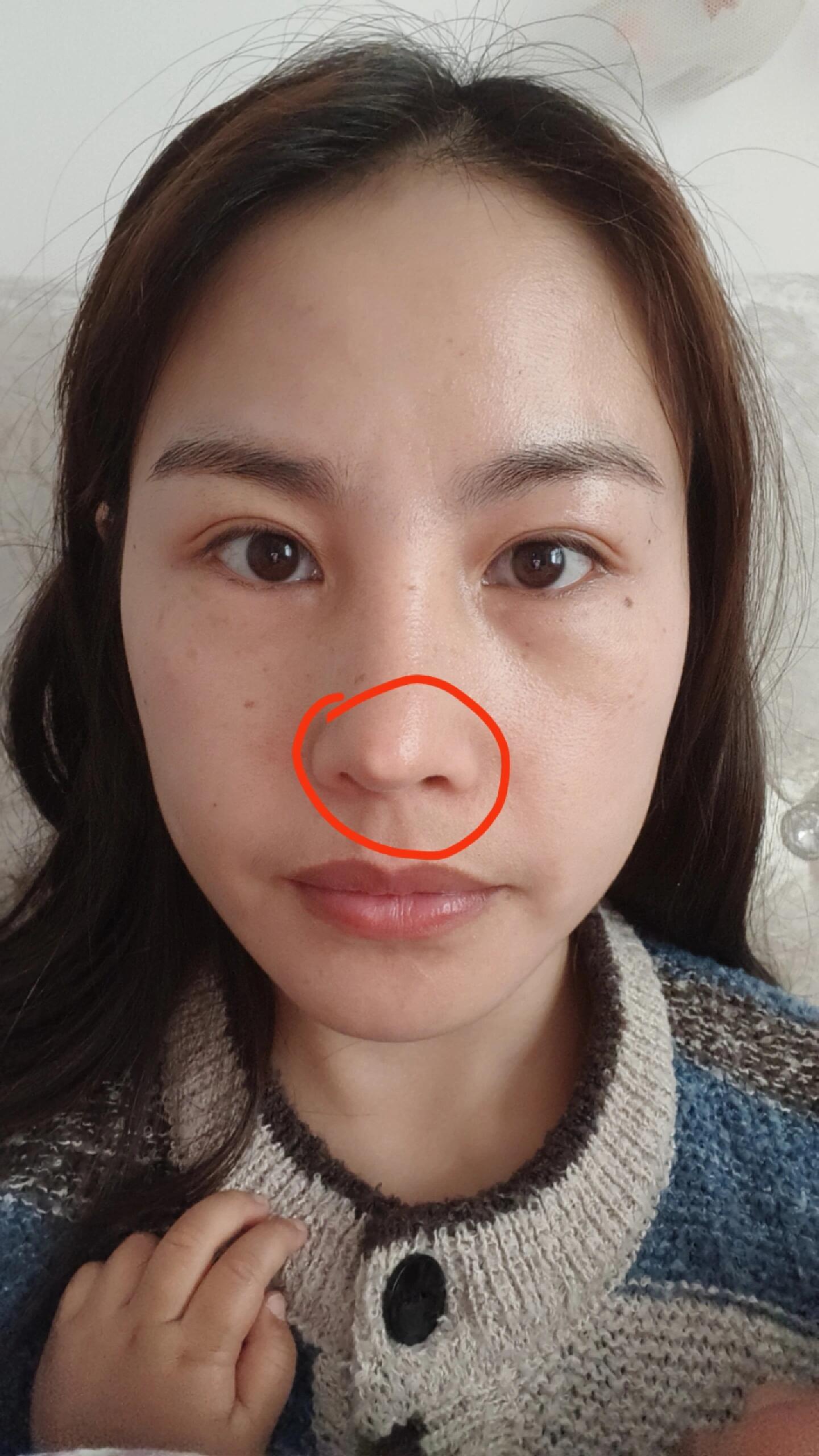 鼻子取出