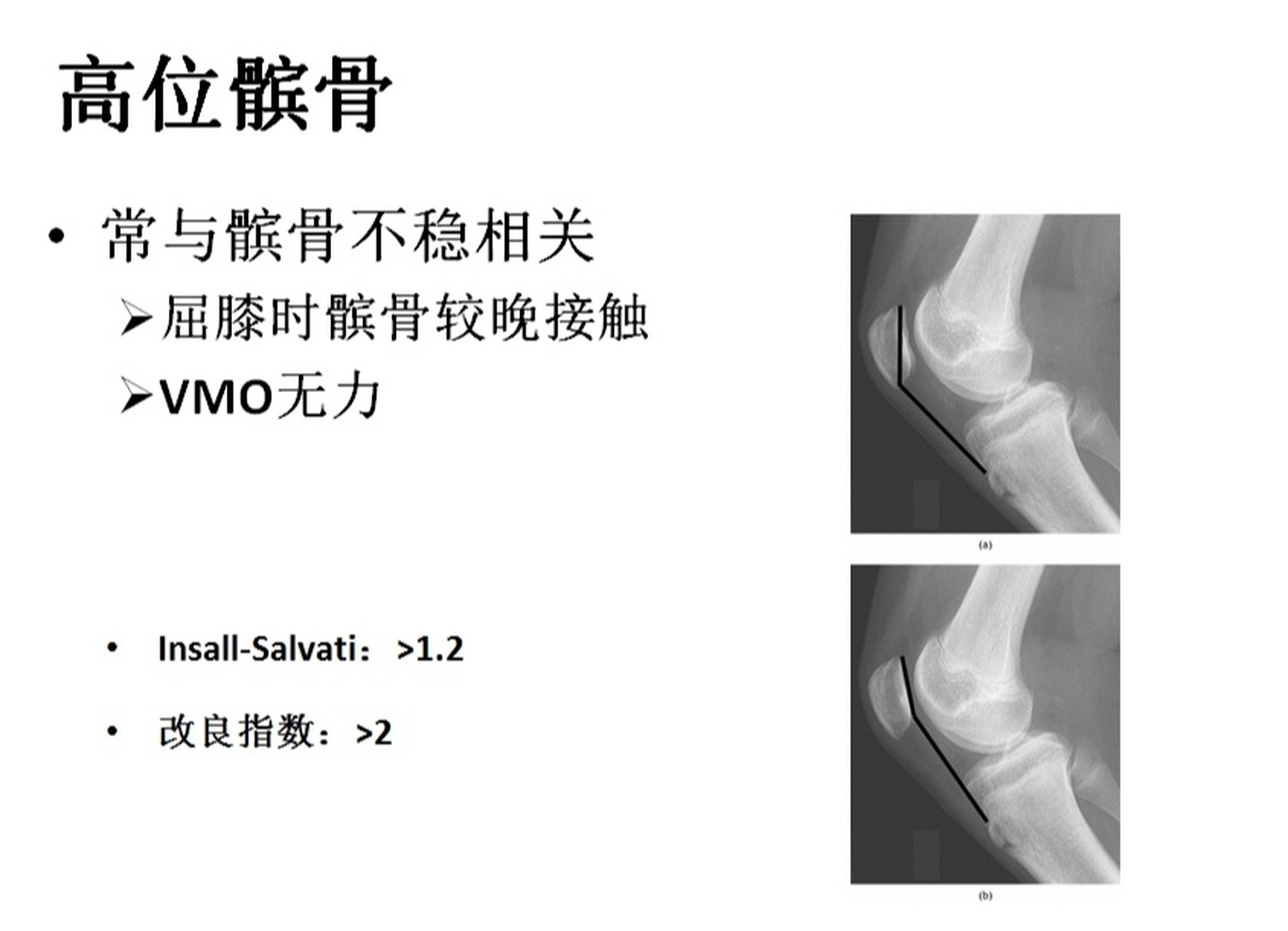 髌骨高位诊断标准图片