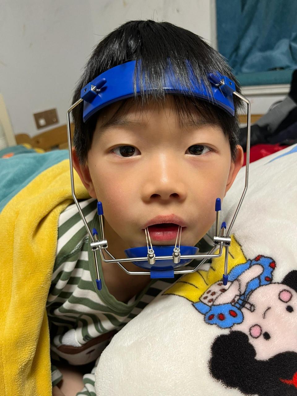 地包天矫正之路 第一次带牵引,由于我家说是骨性遗传,可惜双方父母家