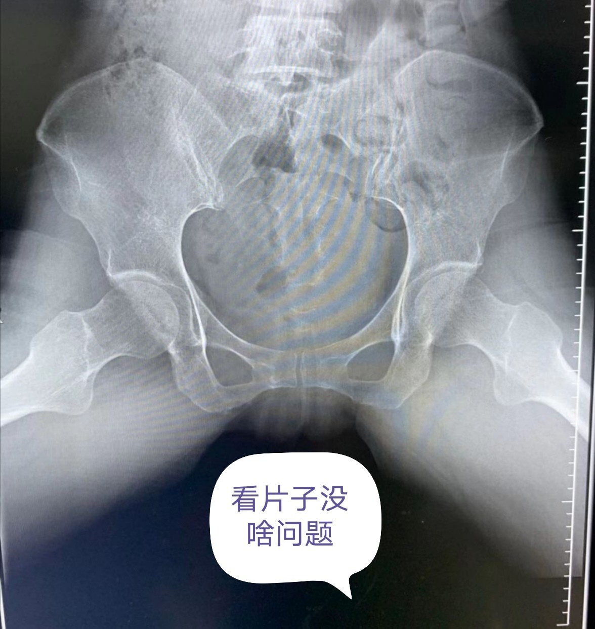 年轻的女性髋关节总是疼痛,x光片却没有问