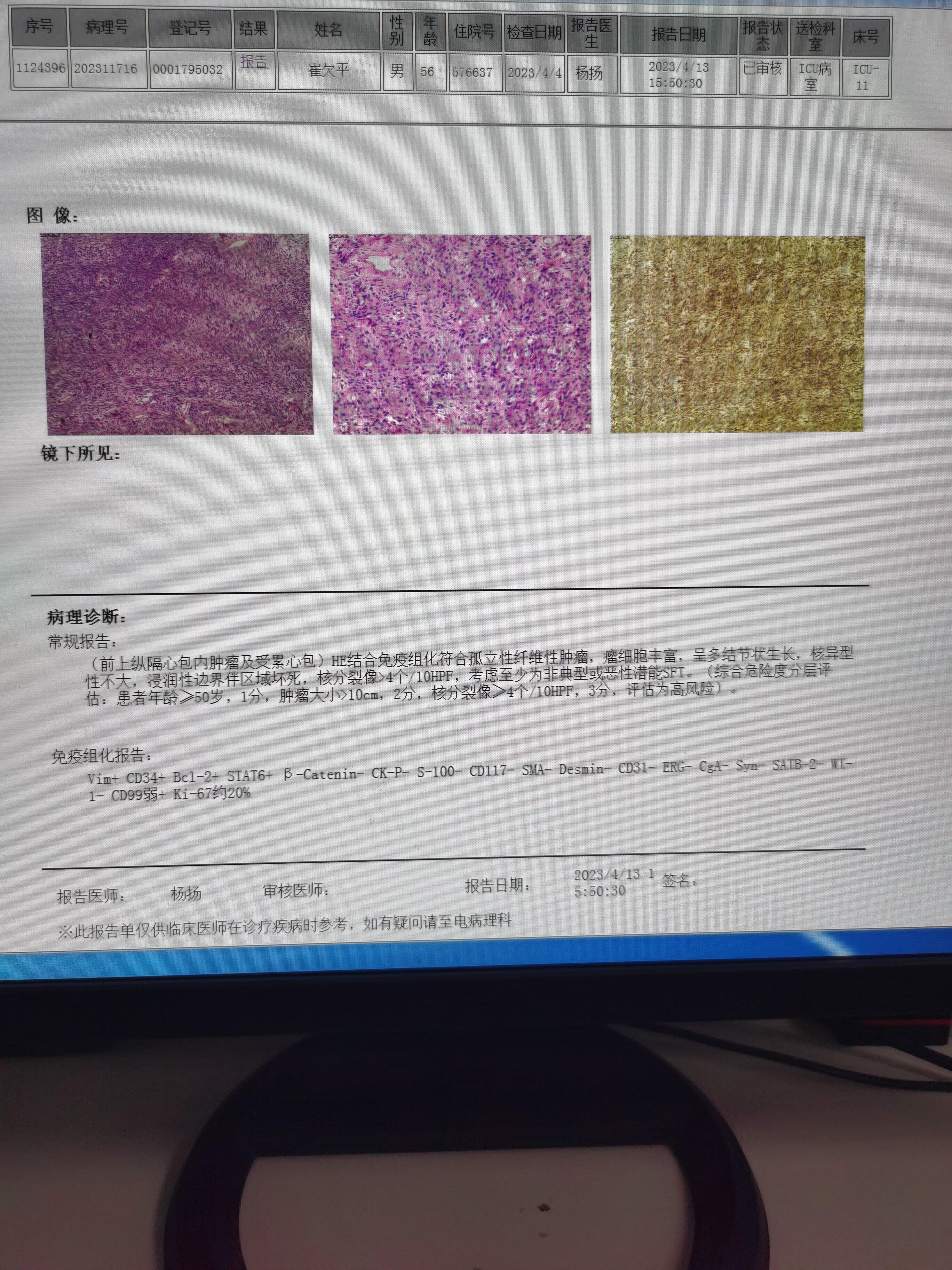 孤立性纤维瘤 的想法 孤立性纤维瘤 有没有经验的老前辈,这病后续