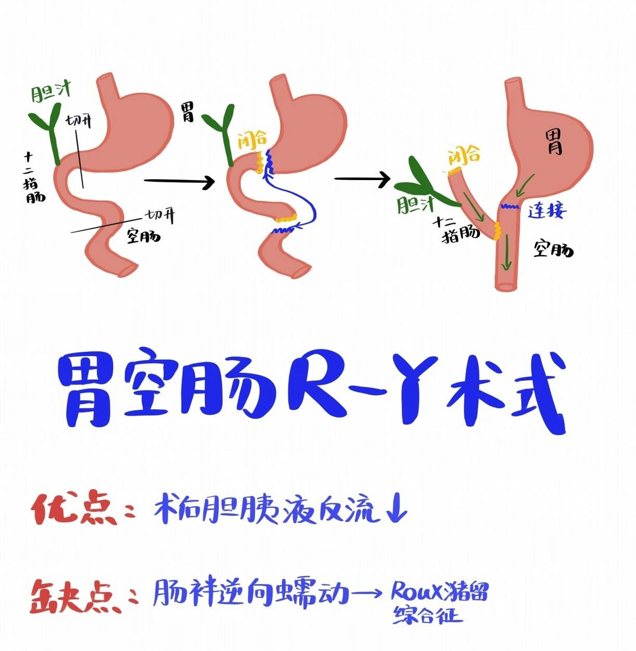 胃切除手术方式图片图片