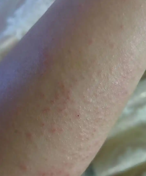 晚上身上痒,一抓就红一片还凸起,最常见的原因是皮肤干燥,过敏或湿 