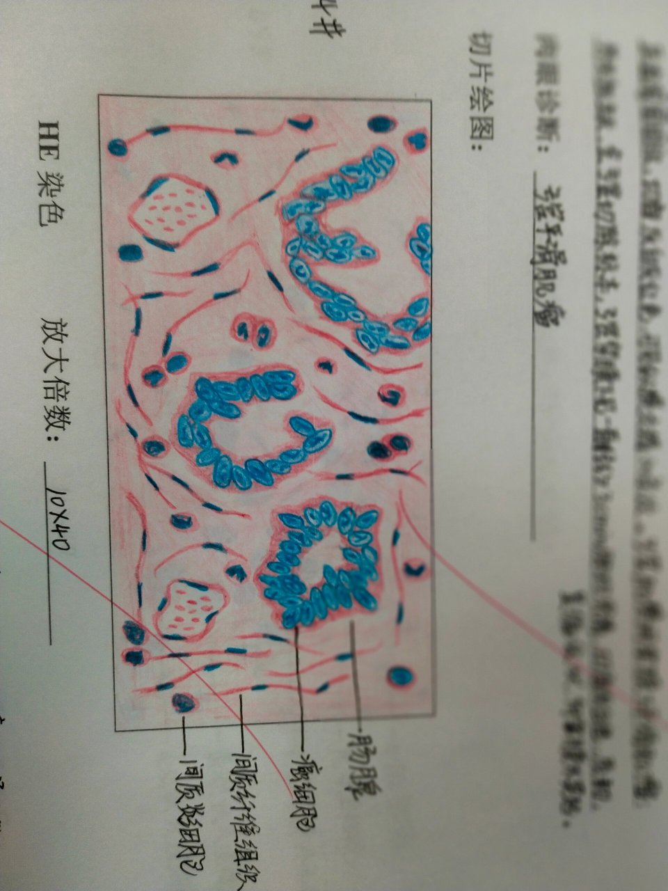 直肠腺癌红蓝铅笔绘图图片