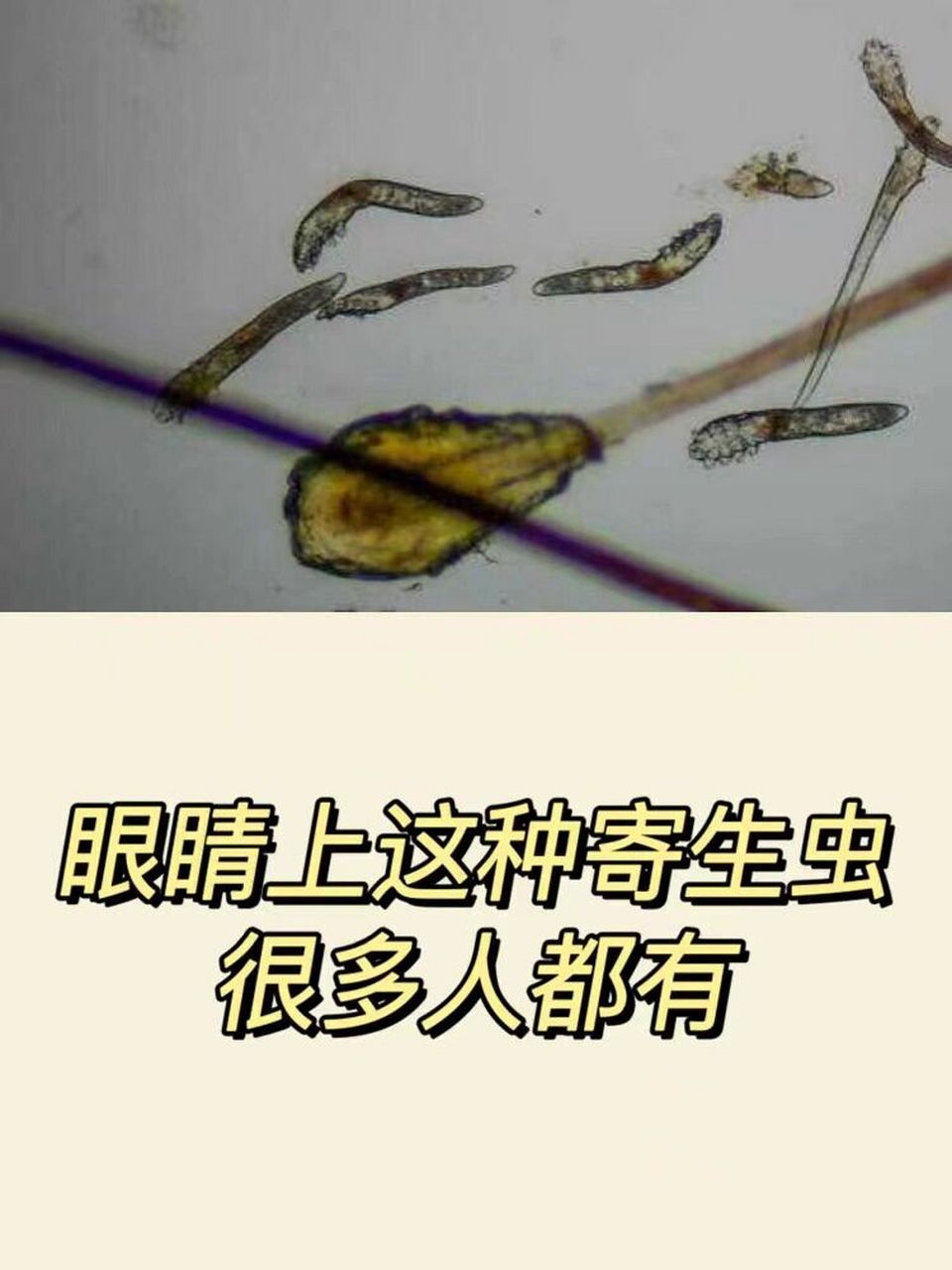 很多人都有 眼睛上的这种寄生虫,很多人都有,叫蠕形螨