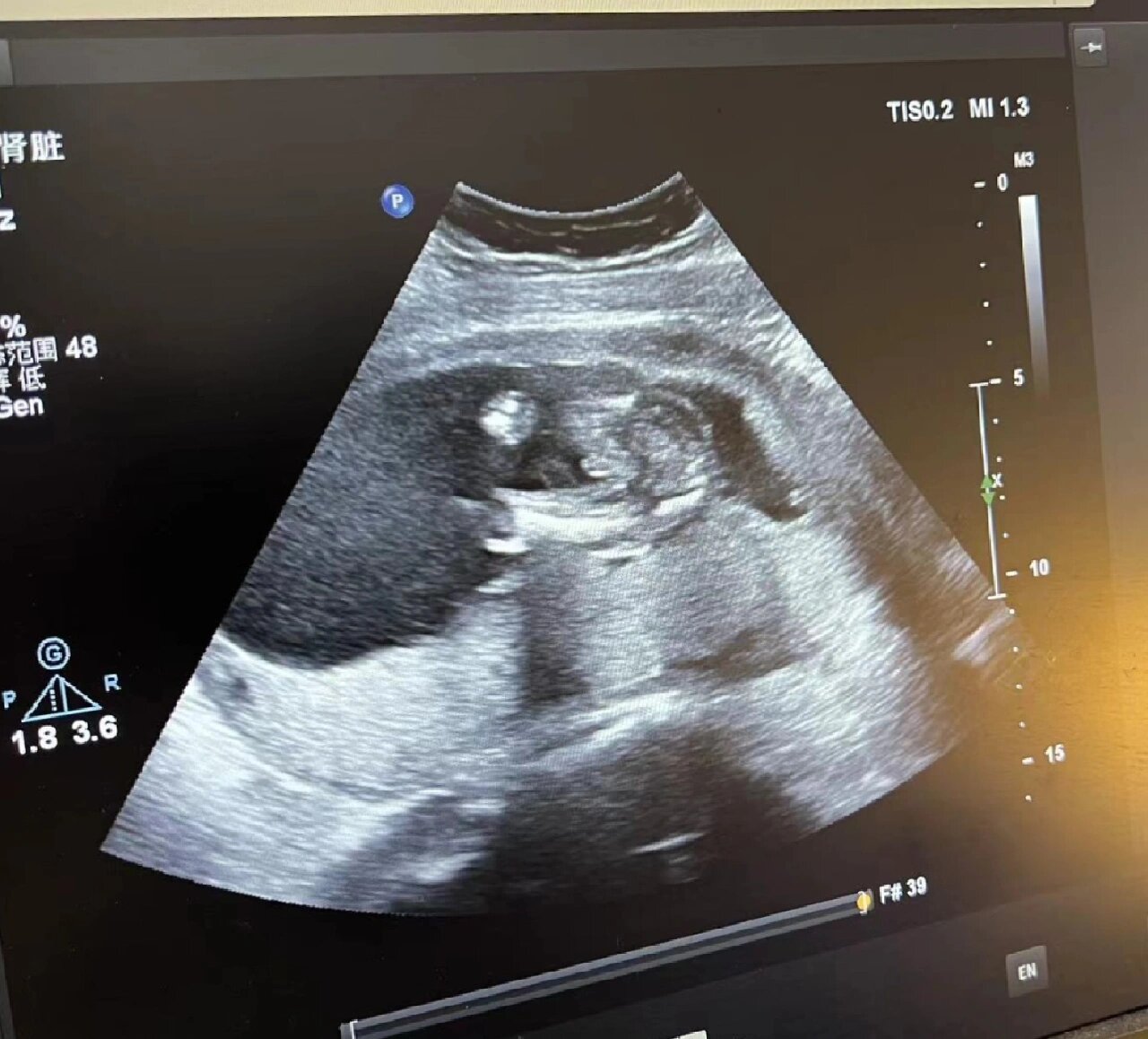19周b超宝子 一转眼怀孕19周啦,前几天做了b超,这是男宝宝吧