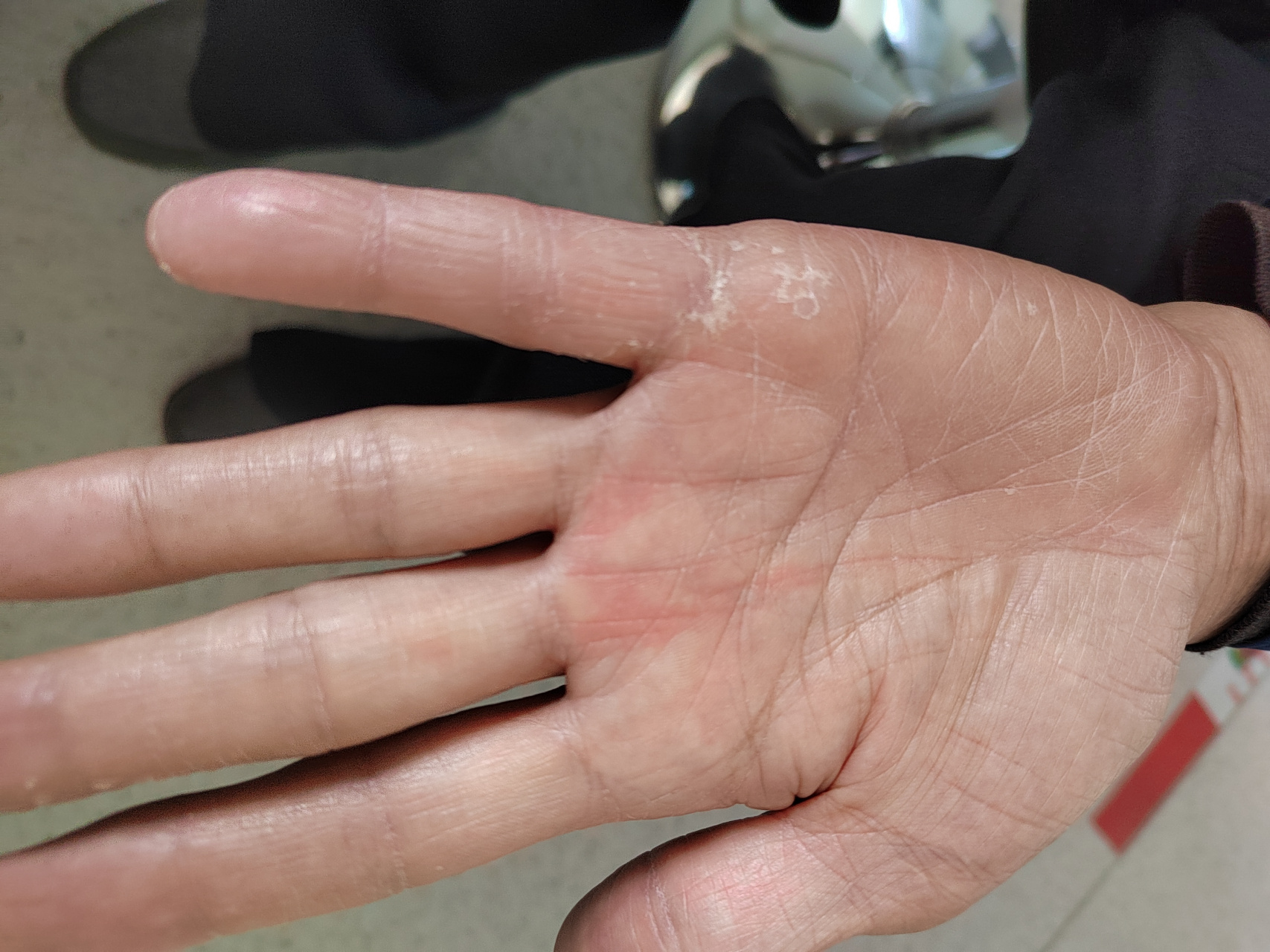 双侧手掌干燥脱屑症状.考虑汗疱疹和手癣可能.