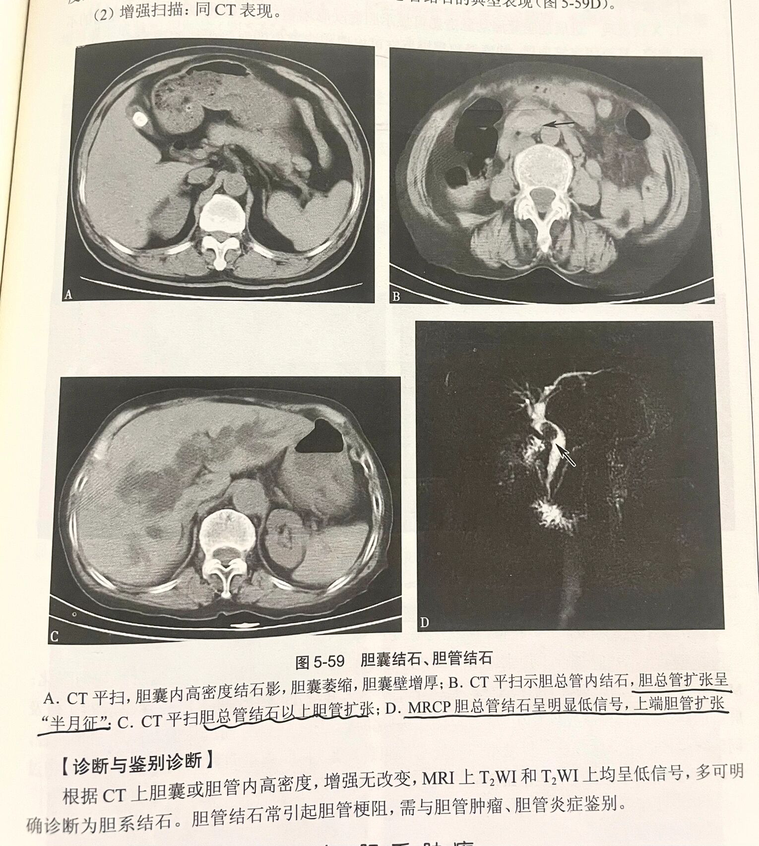 胆管结石CT图片