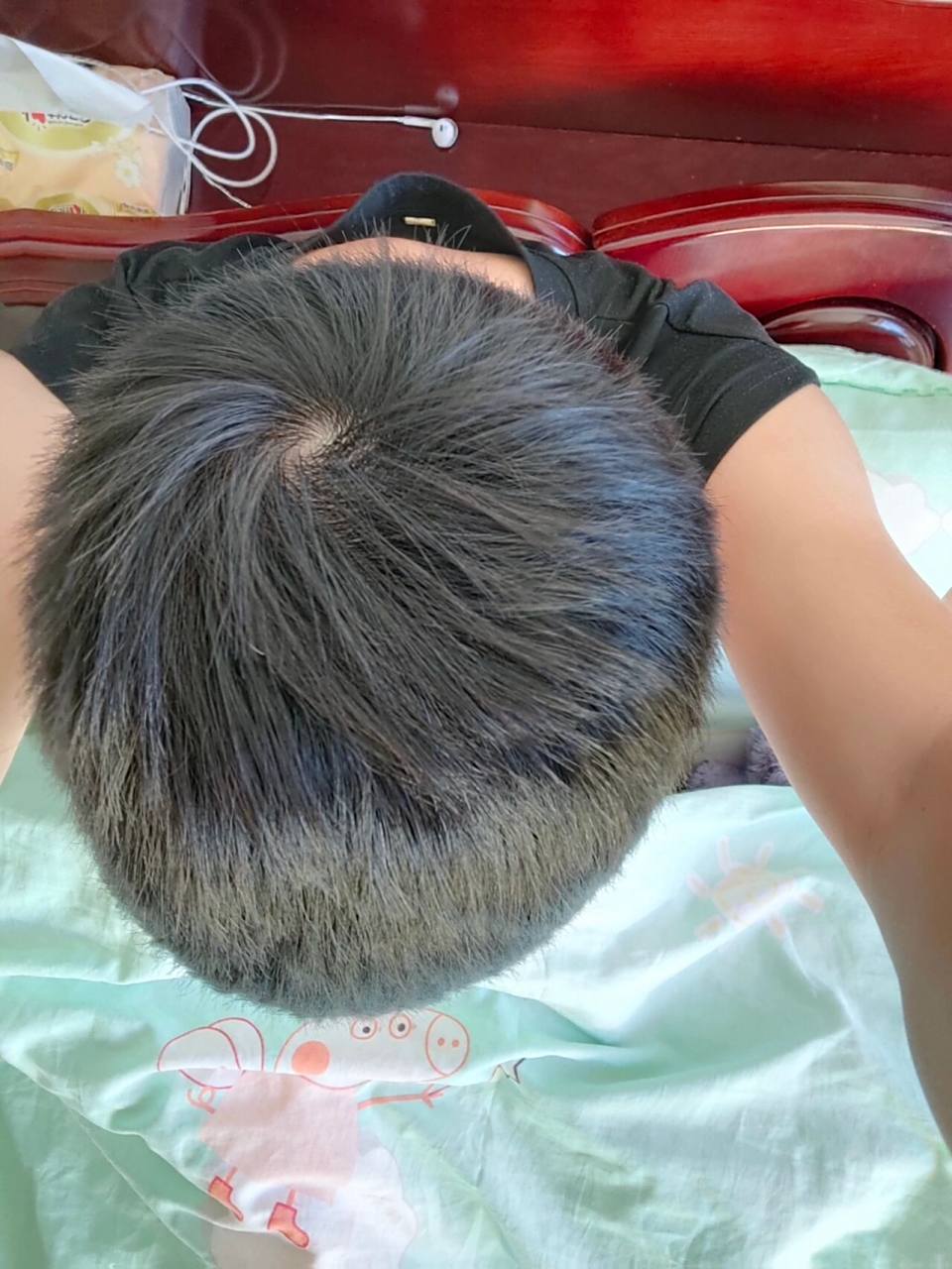 发旋这一圈头发感觉稀少啊