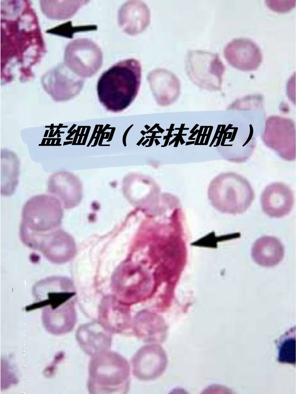 蓝细胞 | 涂抹细胞 | 血细胞形态学检查 9702	 0669♂15