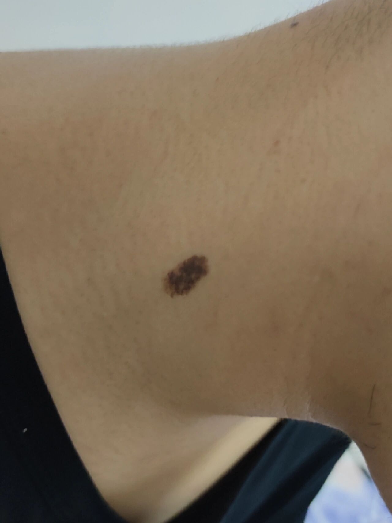 脖子上有黑色的一块 是黑色素沉着还是黑色素瘤啊? 用不用做手术啊?