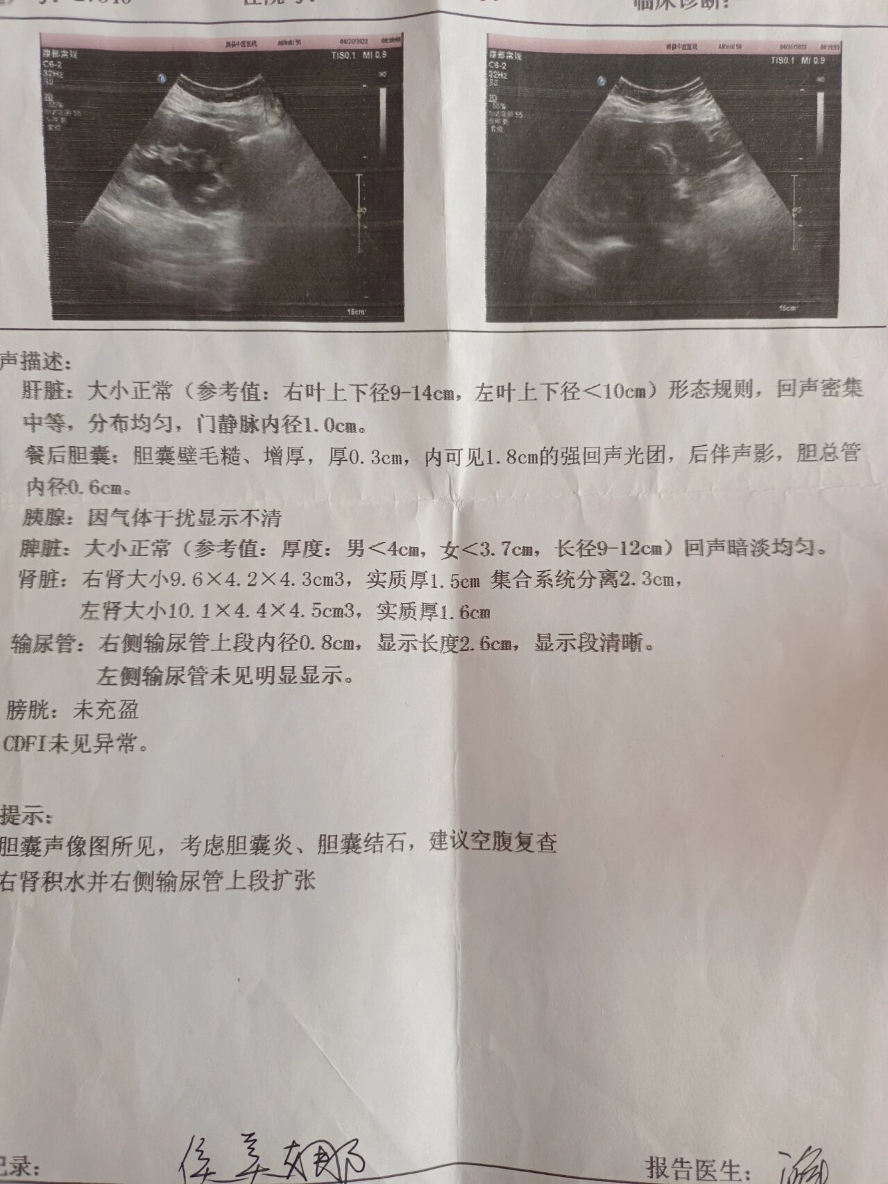 胆结石,充满型无症状胆结石