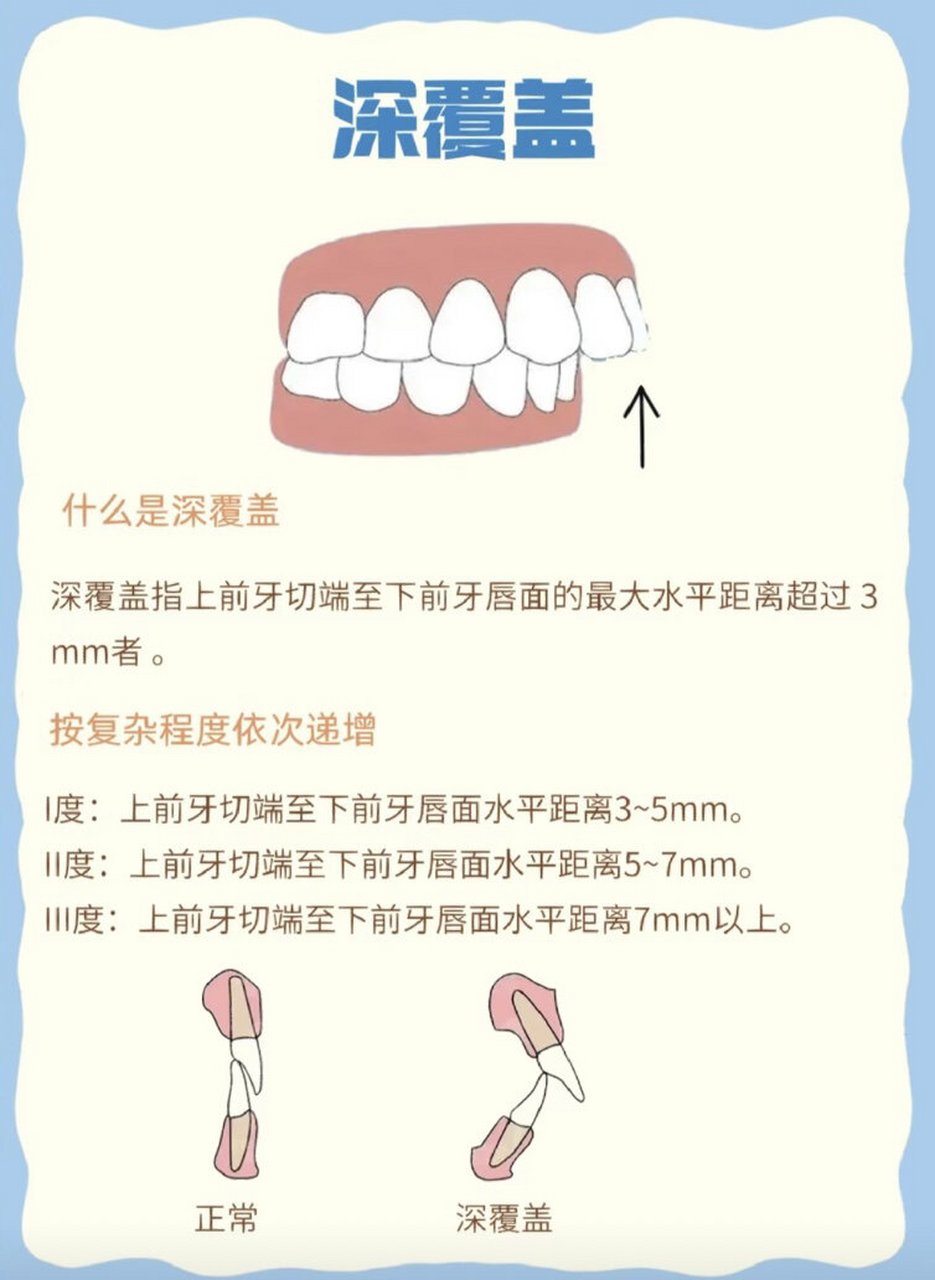 牙齿深覆合和深覆盖图片