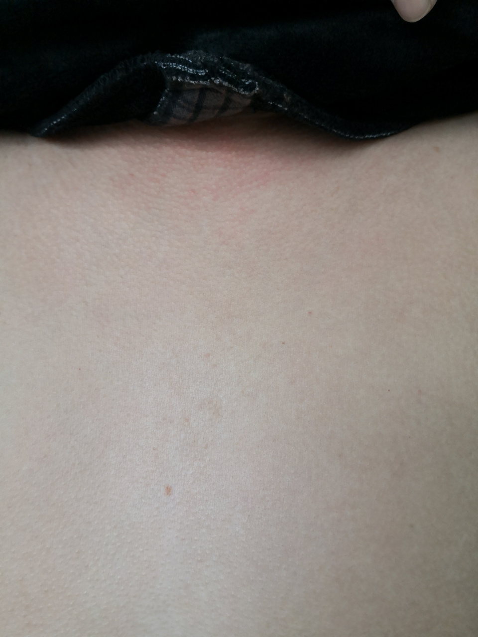 真菌镜检阳性.#真菌