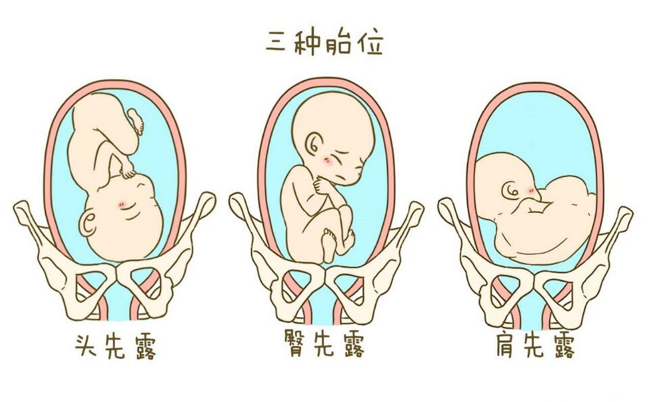 生产前三种常见的宝宝胎位 99我们今天就来讲讲关于胎位的那些事