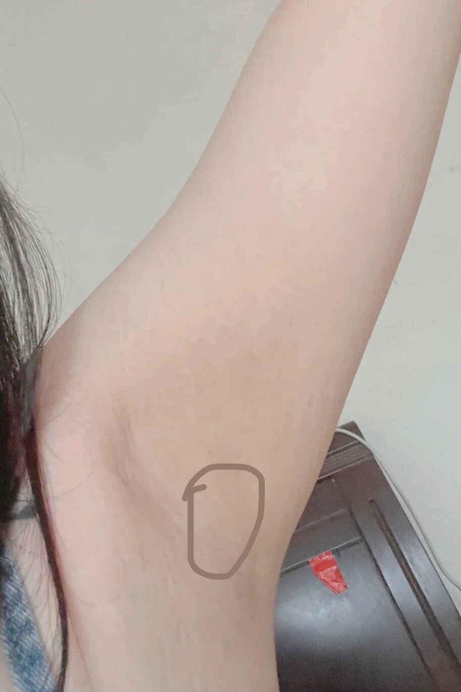 腋下长了个小包