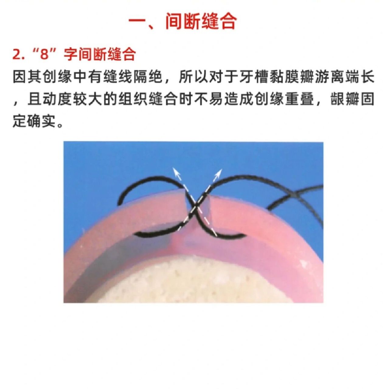 口腔常用的缝合方法及注意事项图解