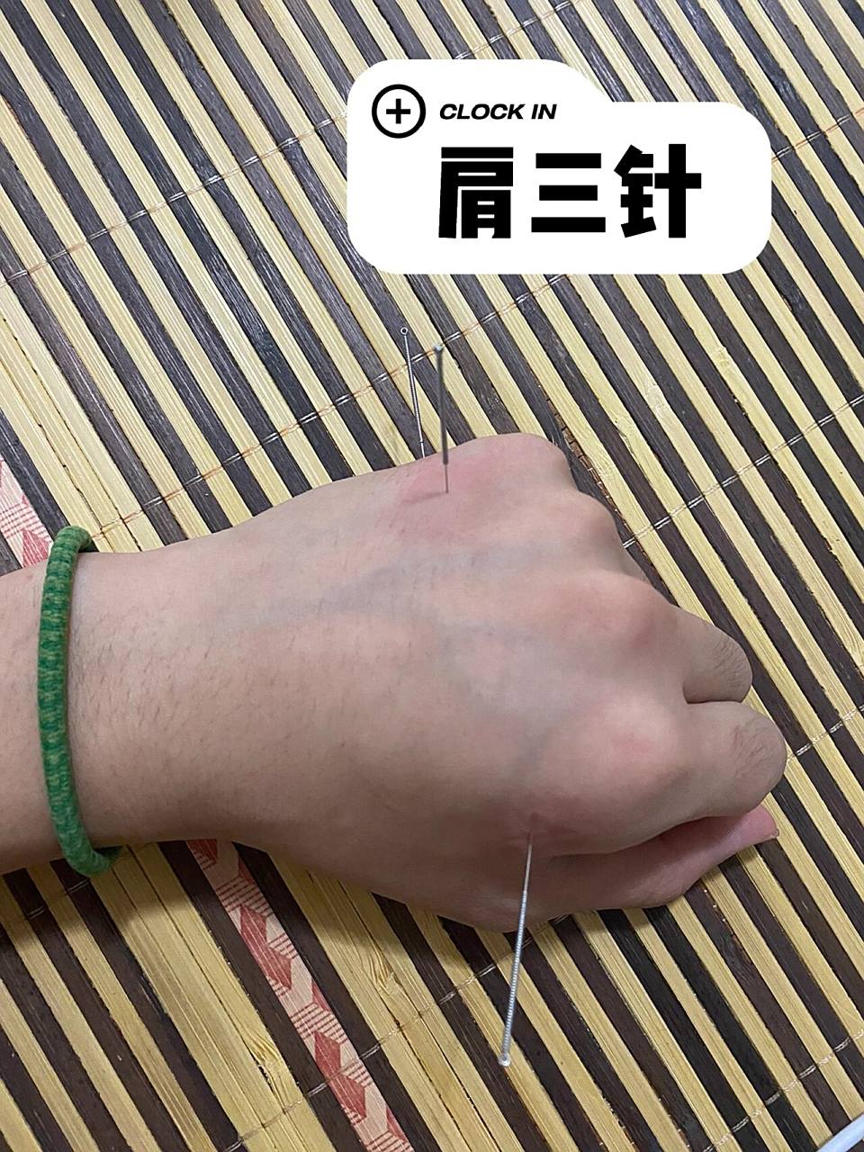 针灸练习——肩三针 准大二生练习扎针,有错误的地方等待大佬纠正穴位