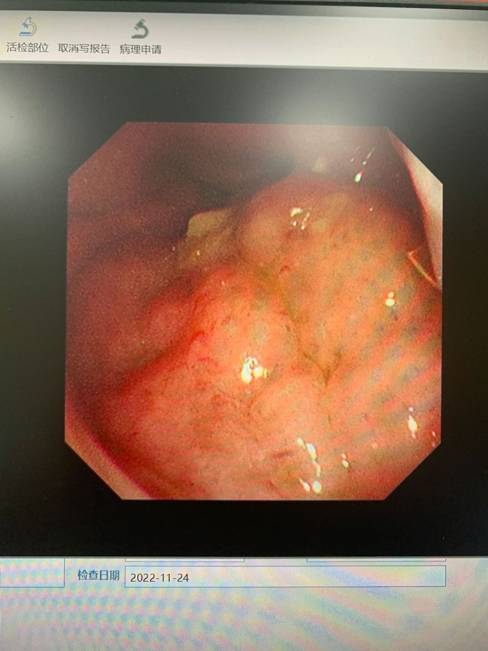 鼻咽癌,看这些症状可以判断 鼻咽癌是很多朋友担心的问题 当你出现血