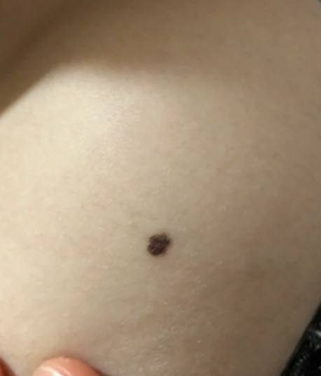 手背出现黑斑常见原因有五种:扁平疣,老年疣,痣,胎记和晒斑