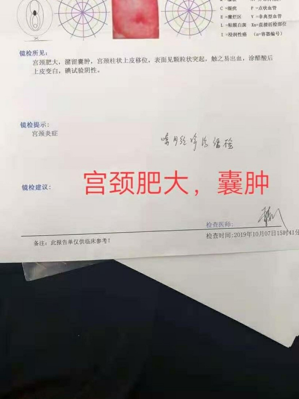 宫颈体腺69囊肿:676005 又称纳博囊特69肿.