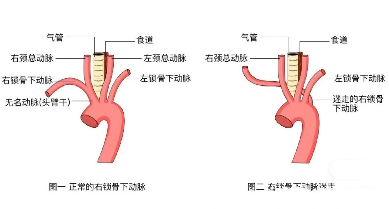 主动脉弓位置示意图图片