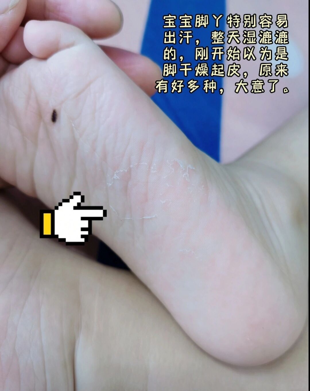 4分钟看明白,宝宝脚丫脱皮怎么办?