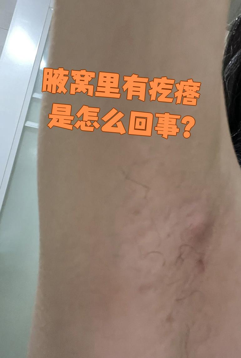 腋窝里摸到疙瘩可能是这些情况: