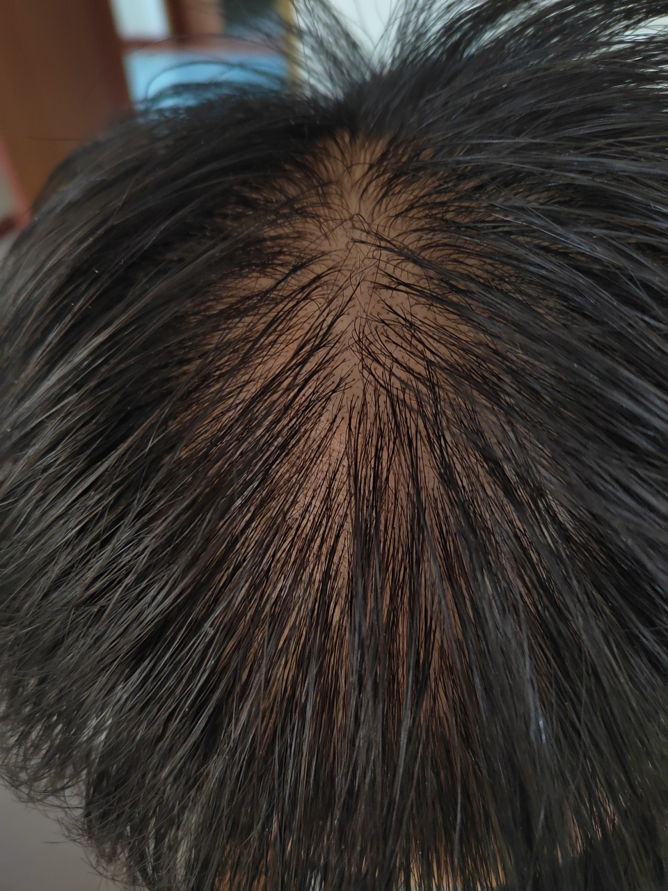 雄激素性脱发.#脱发# 治疗半年左右后,脱发数量变少,头皮油腻减轻.