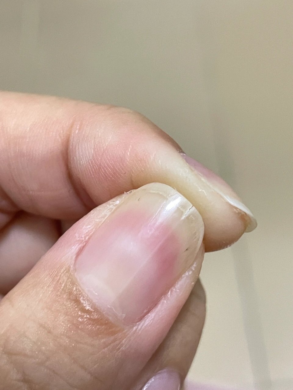 大拇指指甲有一条从根部开始的裂痕,长出来一点就会裂开这是怎么回事