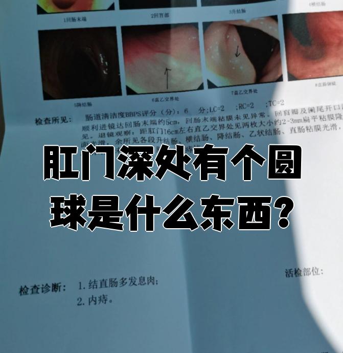 肛门深处摸到圆球样的东西,可能有好几种原因