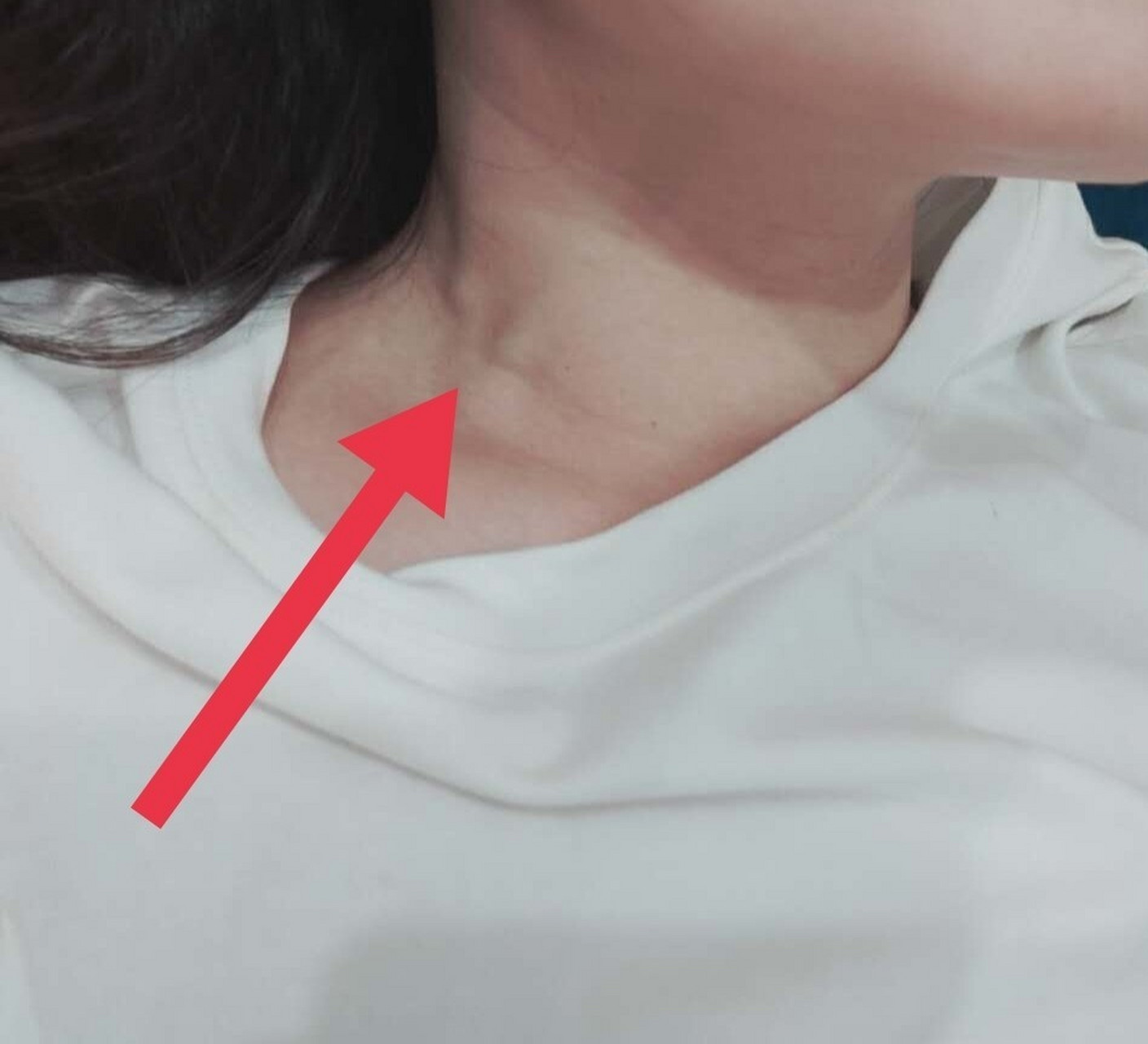 躺下时脖子上血管超级突出 从去年8月份开始,发现晚上睡觉时脖子上